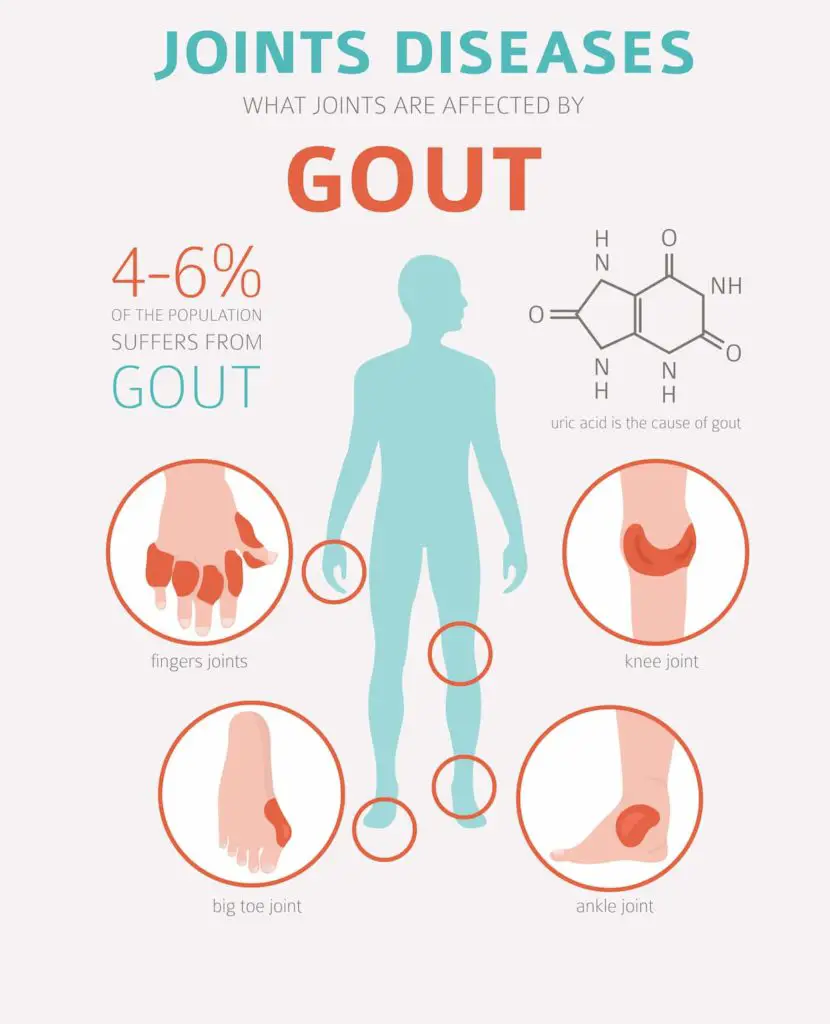 Infographic on Gout - Does a Carnivore Diet Cause Gout