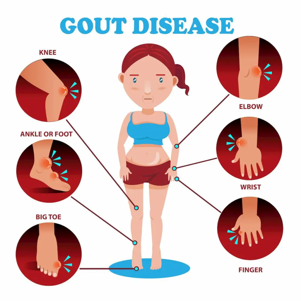 Gout Locations Chart - Does a Carnivore Diet Cause Gout