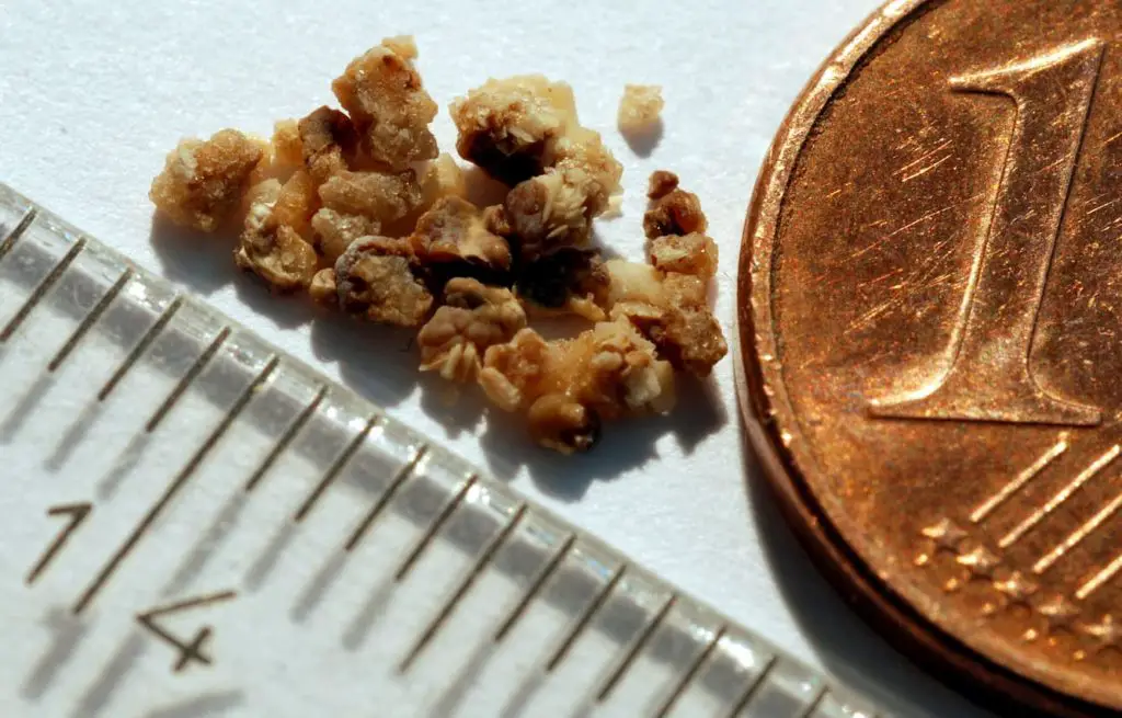 Kidney stones in size compared with cents and Ruler - Post about Does a Carnivore Diet Cause Kidney Stones